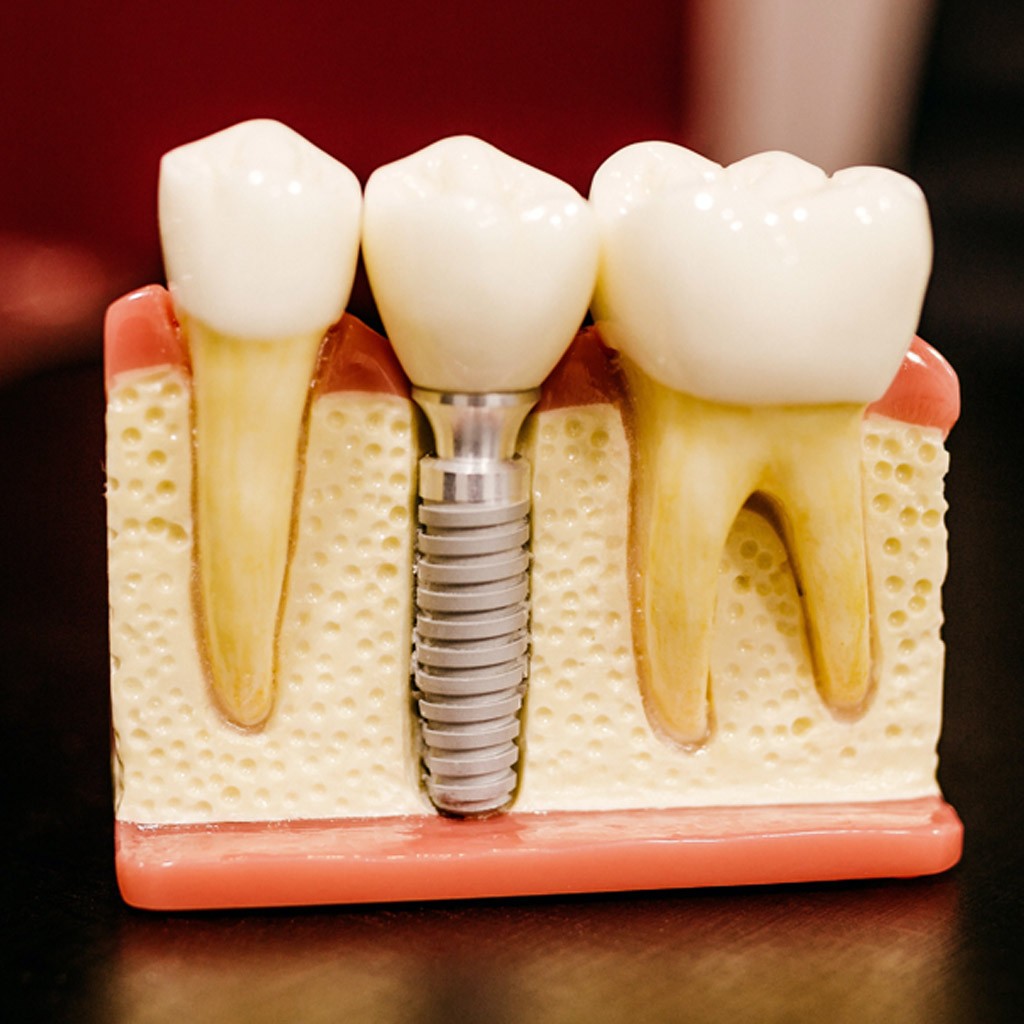 El precio de un implante dental