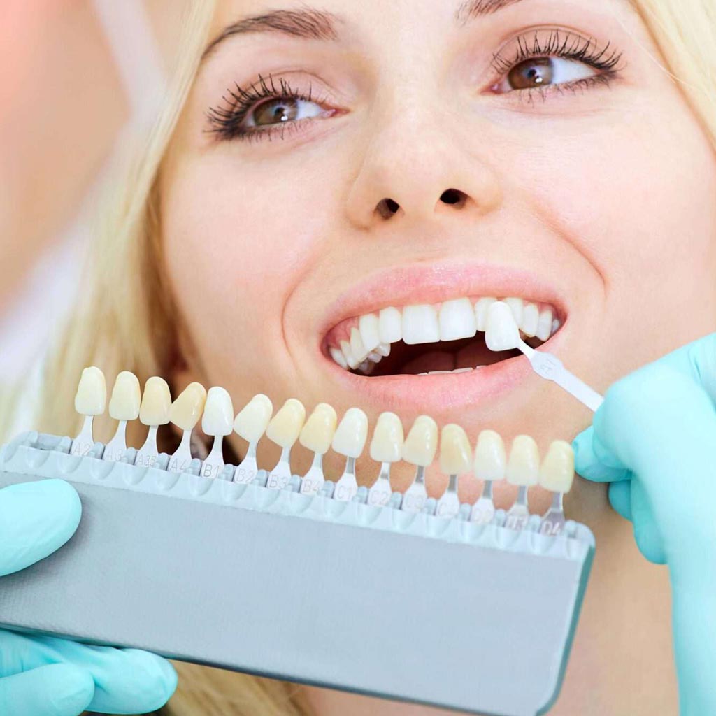Corona dental: qué es y cuándo es necesaria