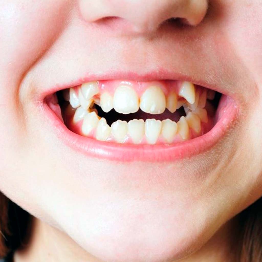 Maloclusiones dentales en niños