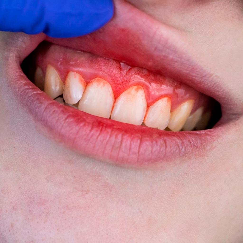 Piorrea dental